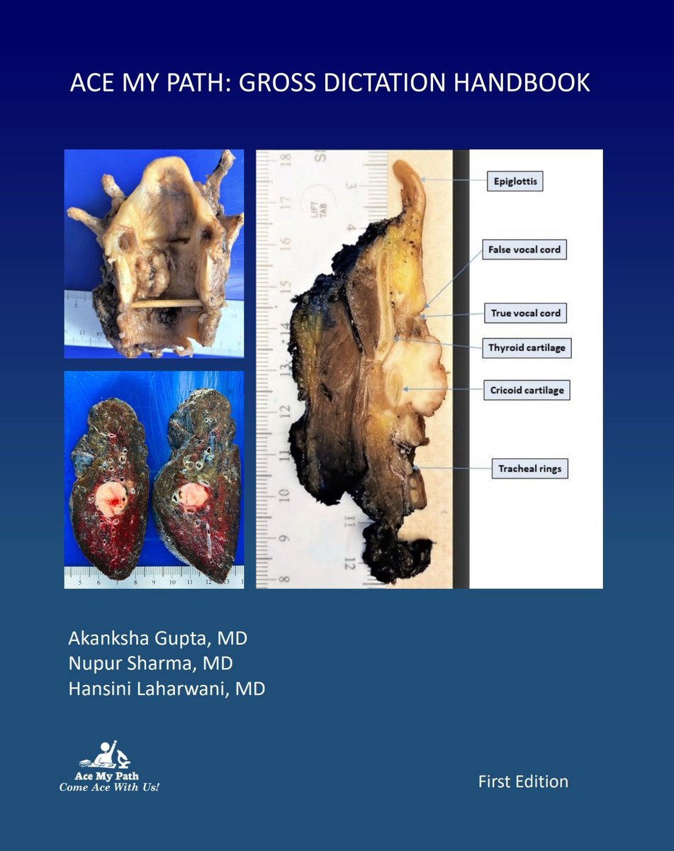 Hansini Laharwani (@hansinimd) on Twitter photo 6 months of hard work and many sleepless nights led to this brainchild. Check out our grossing dictation book <a href="/AceMyPath/">Ace My Path</a>. It's all here and in a user friendly format! @Hemepath_Doc <a href="/NupursharmaMD/">Nupur Sharma, MD</a> <a href="/Dr_Brian_Cox/">Brian Cox, MD, MAS</a>
amazon.com/dp/B09QK6GTPR/… 6 months of hard work and many sleepless nights led to this brainchild. Check out our grossing dictation book <a href="/AceMyPath/">Ace My Path</a>. It's all here and in a user friendly format! @Hemepath_Doc <a href="/NupursharmaMD/">Nupur Sharma, MD</a> <a href="/Dr_Brian_Cox/">Brian Cox, MD, MAS</a>
amazon.com/dp/B09QK6GTPR/…