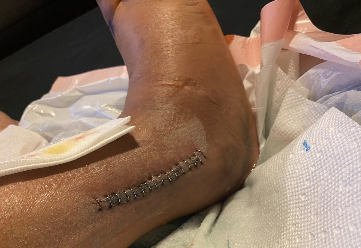 OG_Wheels's tweet photo. One for the tibula, one for the fibula . I waited to post til they didnโt look as gruesome lol #postsurgerylife incision cleaning time https://t.co/1gRg7cu20E