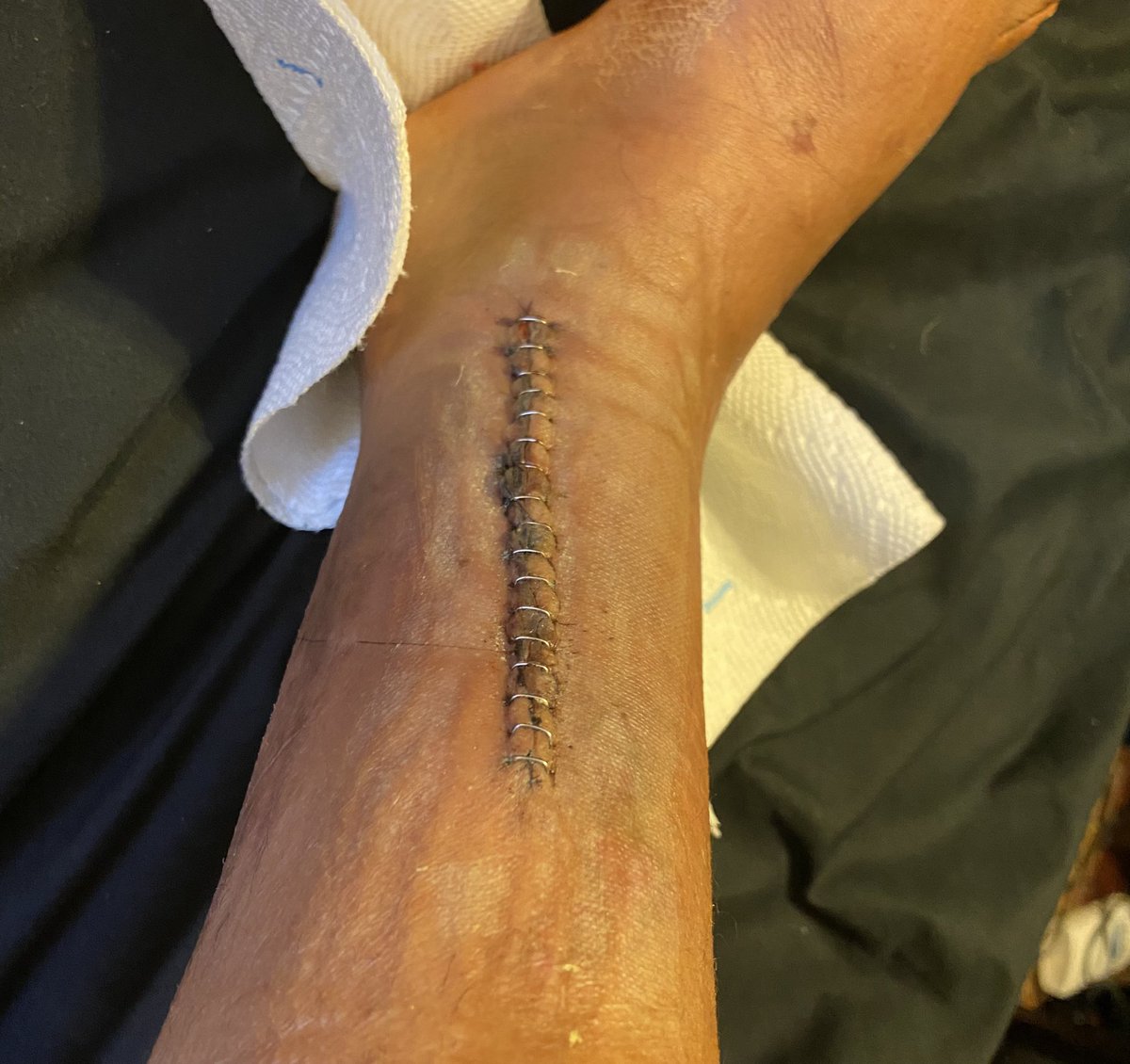 OG_Wheels's tweet photo. One for the tibula, one for the fibula . I waited to post til they didnโt look as gruesome lol #postsurgerylife incision cleaning time https://t.co/1gRg7cu20E