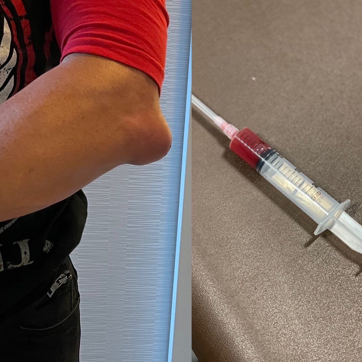 Two Hours before my match with <a href="/LanceHoyt/">The Murderhawk Monster Lance Archer</a> I had a bad case of bursitis and had to have my elbow drained with a syringe. Here are the results. No excuses, as Lance is a killer. But be aware that I am the fucking man I have been for a long time.