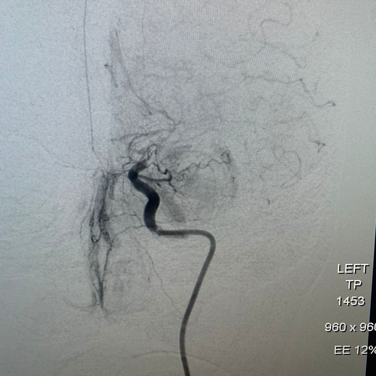 Rapid Medical (@rapid__medical) on Twitter photo First Case Alert 🚨 :
Dr. Ethan Benardete <a href="/ethan_benardete/">Ethan Benardete</a> from <a href="/bswhealth/">Baylor Scott & White Health</a> in Temple Texas treated a terminus stroke in a 65 year old female.
Set up:
BMX 96
RED 72
Phenom 21
#Tigertriever. First Case Alert 🚨 :
Dr. Ethan Benardete <a href="/ethan_benardete/">Ethan Benardete</a> from <a href="/bswhealth/">Baylor Scott & White Health</a> in Temple Texas treated a terminus stroke in a 65 year old female.
Set up:
BMX 96
RED 72
Phenom 21
#Tigertriever.