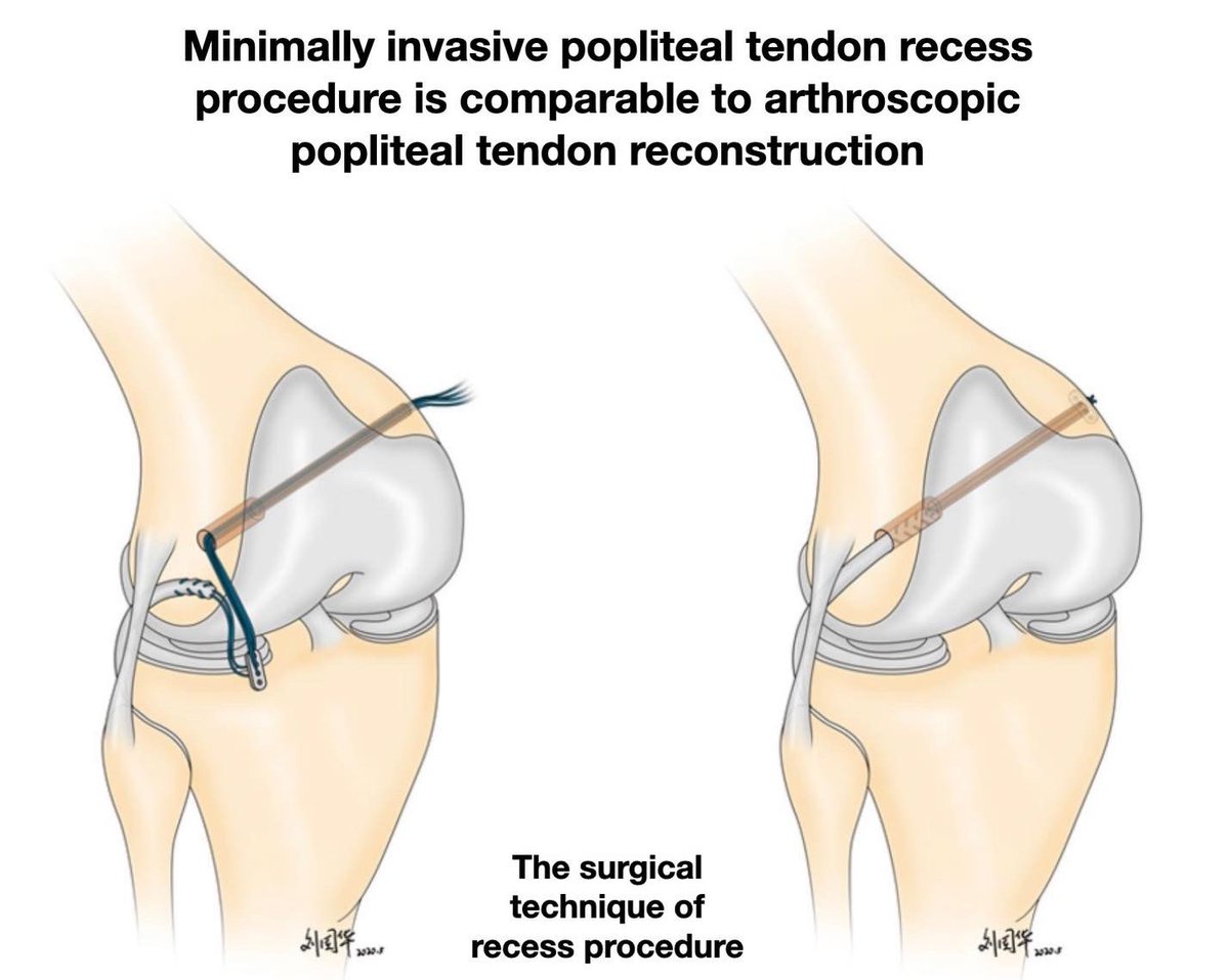 KSSTA's tweet photo. Minimally invasive and graft-free recess procedure can be a viable option, when both PT reconstruction and PT recess procedure are indicated, as both procedure was associated with similar outcome.
#Poplitealtendon #reconstructionsurgery
Link: https://t.co/1UrbJ9WESH https://t.co/heBERtBoJS