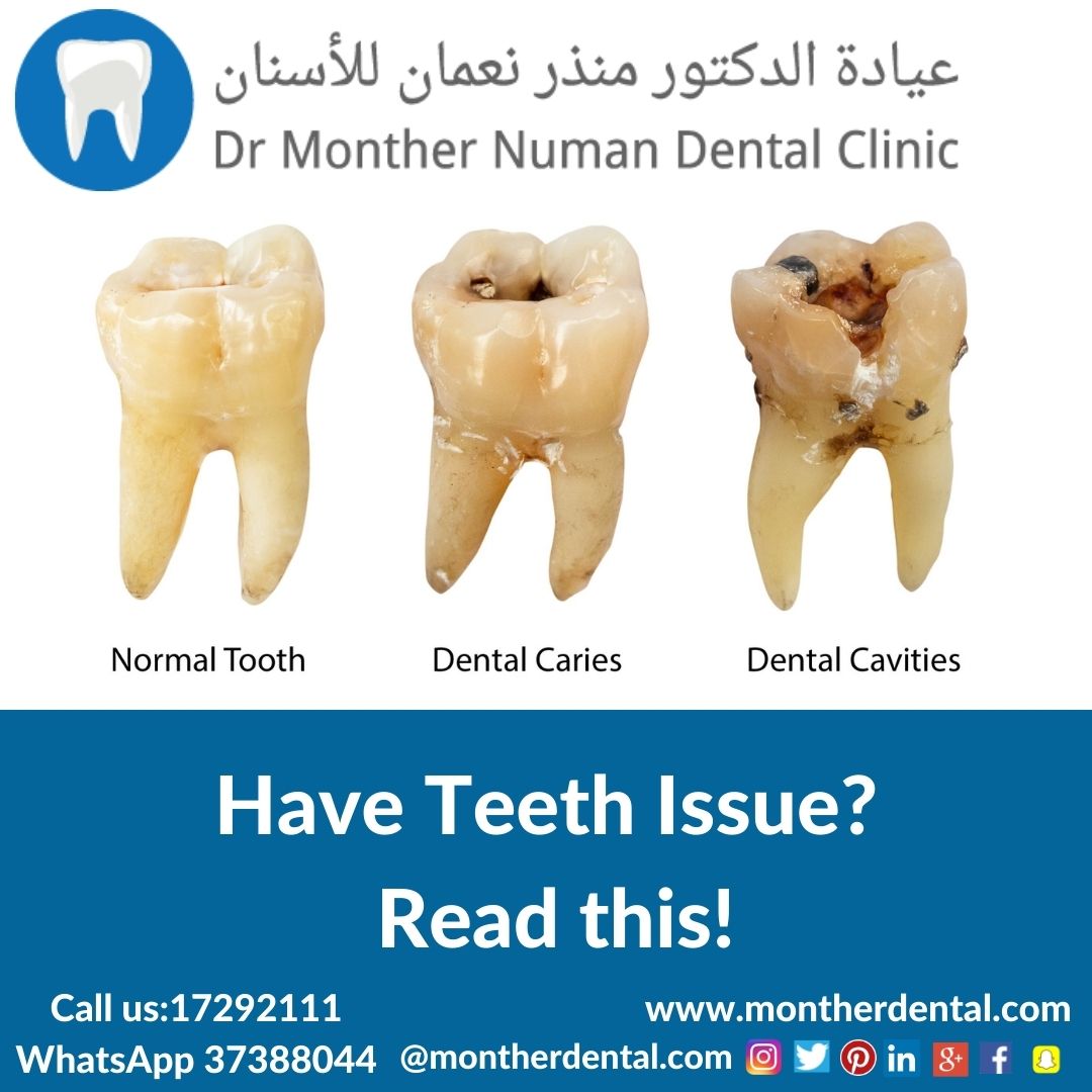 montherdental's tweet photo. Cavities- Is a small hole in the tooth, it is damage on your tooth enamel the hard outer layer of teeth. When we eat or drink which contains sugar, the bacteria in plaque produce acids that attack tooth enamel. #commondentalproblems #teethissues #toothache #teethcavitiy https://t.co/5etE7ztxlu