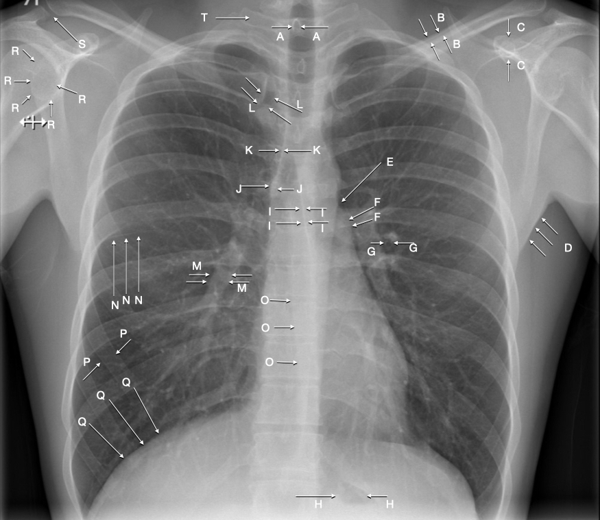 Everyone likes an CXR anatomy quiz, don't they? 

But particularly those approaching the First FRCR Anatomy in March. I'll post the answers next week