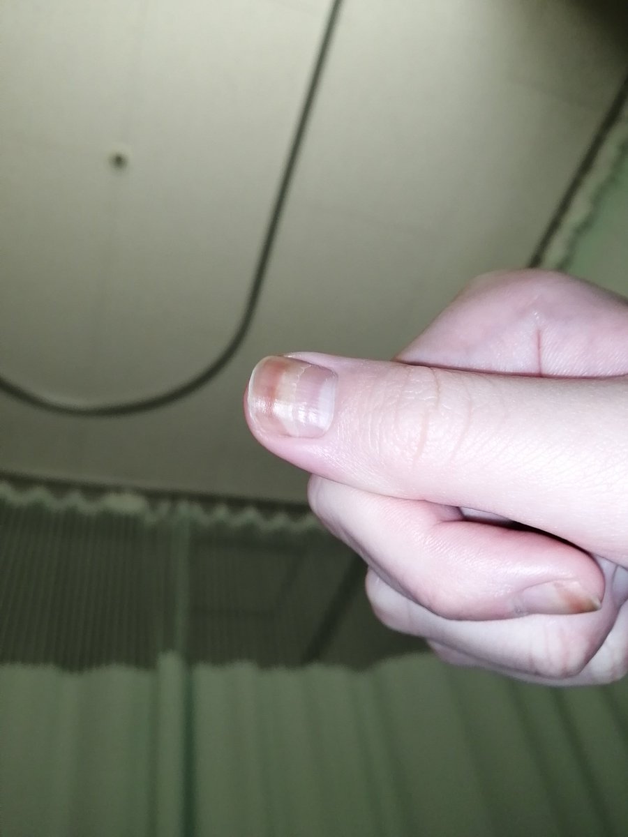 Kaaaaa_a_aaa's tweet photo. 【拡散希望】
先日癌のため入院しました。

隣の方に「これ癌に効くから」「癌細胞が消えたらしいよ」「病院の人には見つからないようにしなさい」と言われ入院時にハサル液なるものを渡されました。

しかし、使ってみると爪が変色しました。癌も良くなる傾向がありません。
#ハサル液 https://t.co/LblF1uXYEZ