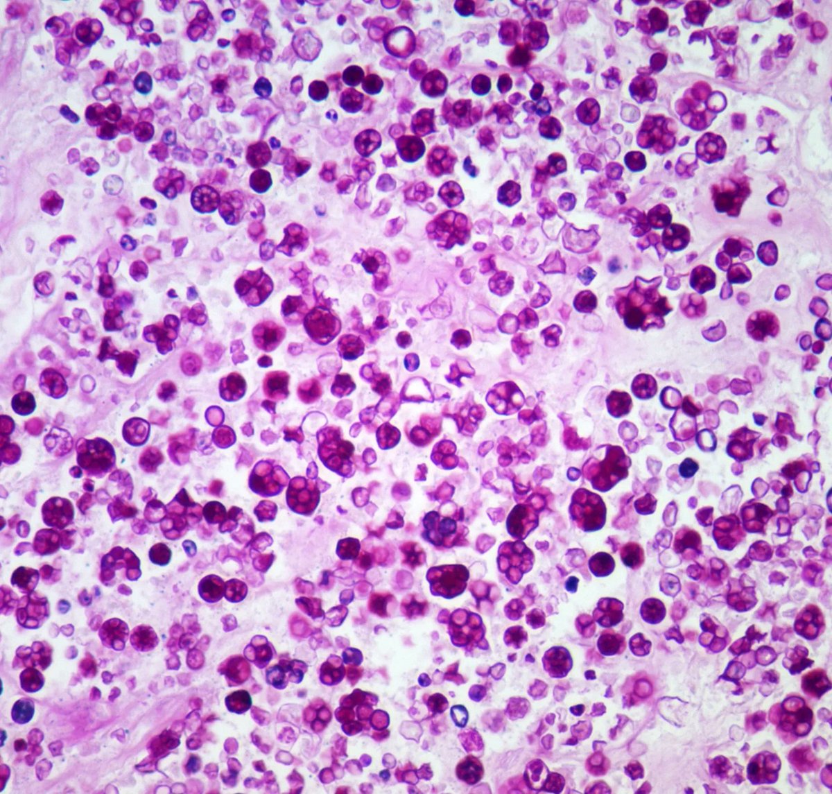JMGardnerMD's tweet photo. BEST example EVER of ultra-rare disease! Elderly man, hx of lymphoma, leg mass arose weeks after he cut leg on wood in garden. HE, PASD, GMS. WSI: https://t.co/23SX2WlsRd. Answer: https://t.co/kg2aHtghtL. #pathology #pathologists #pathTwitter #dermpath #dermatology #dermtwitter https://t.co/Rc2CJwsA63