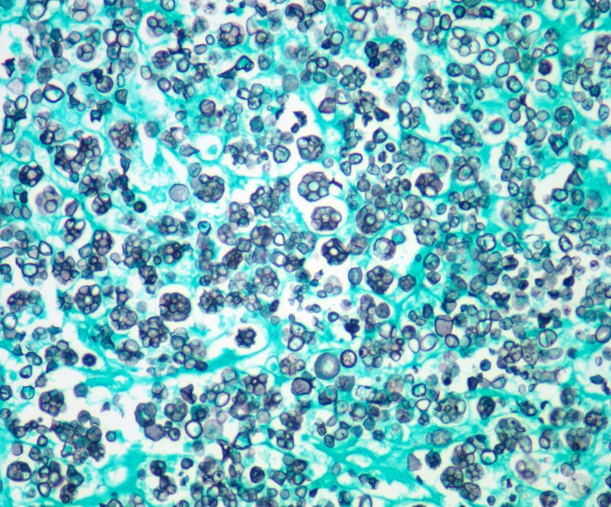 JMGardnerMD's tweet photo. BEST example EVER of ultra-rare disease! Elderly man, hx of lymphoma, leg mass arose weeks after he cut leg on wood in garden. HE, PASD, GMS. WSI: https://t.co/23SX2WlsRd. Answer: https://t.co/kg2aHtghtL. #pathology #pathologists #pathTwitter #dermpath #dermatology #dermtwitter https://t.co/Rc2CJwsA63