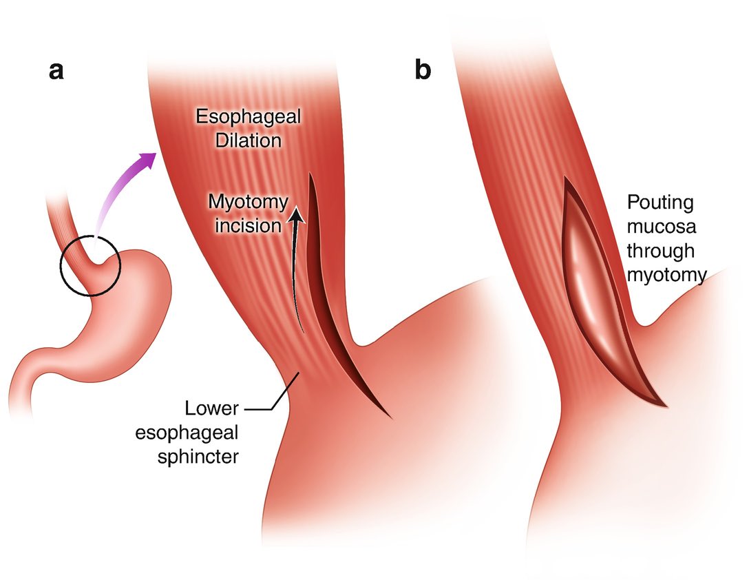 On April 14, 1913, German surgeon Ernst Heller (1877-1964) performed the first extramucosal myotomy on the esophagus of a 49 year old male patient with achalasia. The Heller myotomy is still in use, though typically now done laparoscopically.