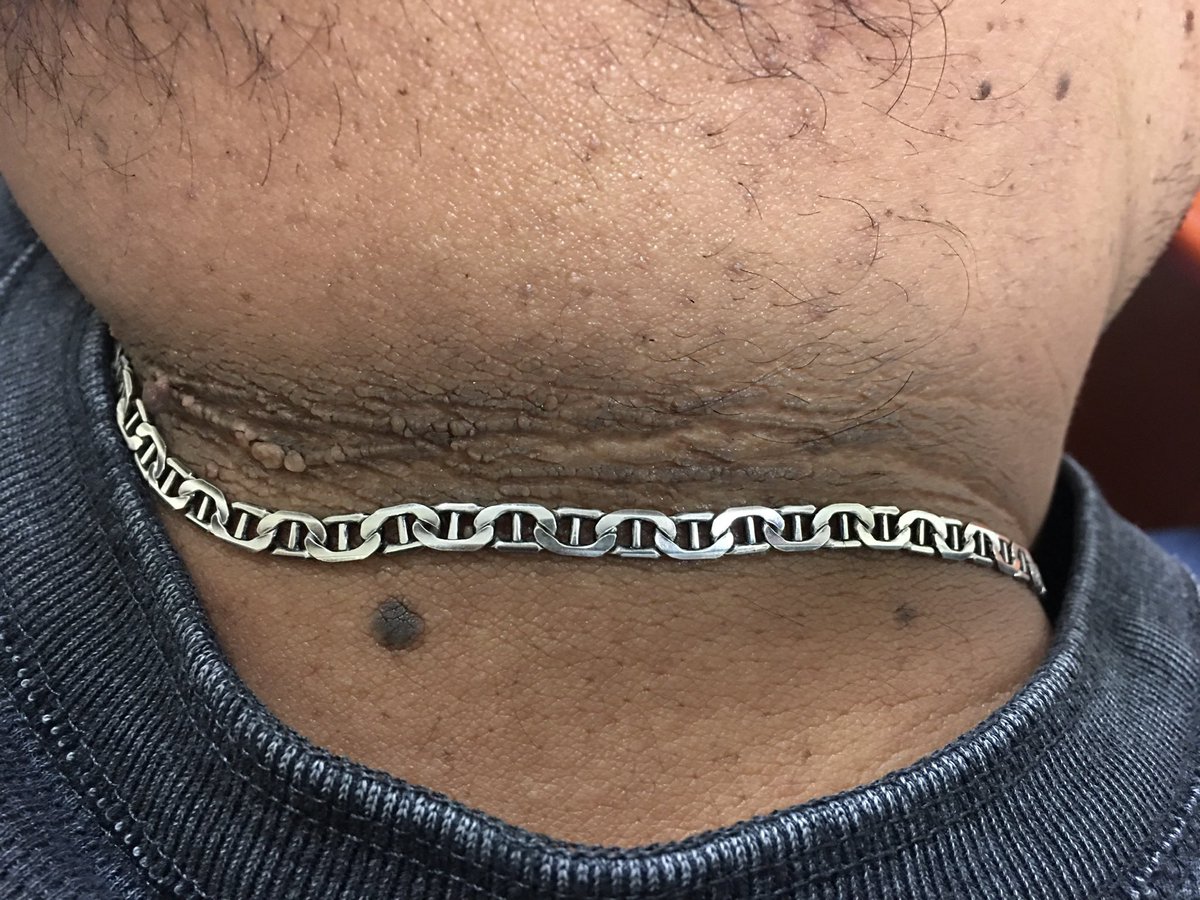 La acantosis nigricans es una zona aterciopelada de la piel, marrón a negra, en los pliegues del cuerpo, como el cuello y las axilas. En jóvenes aparece con la obesidad y presagia la diabetes. Si se pierde peso, aún puede revertirse aunque toma años.