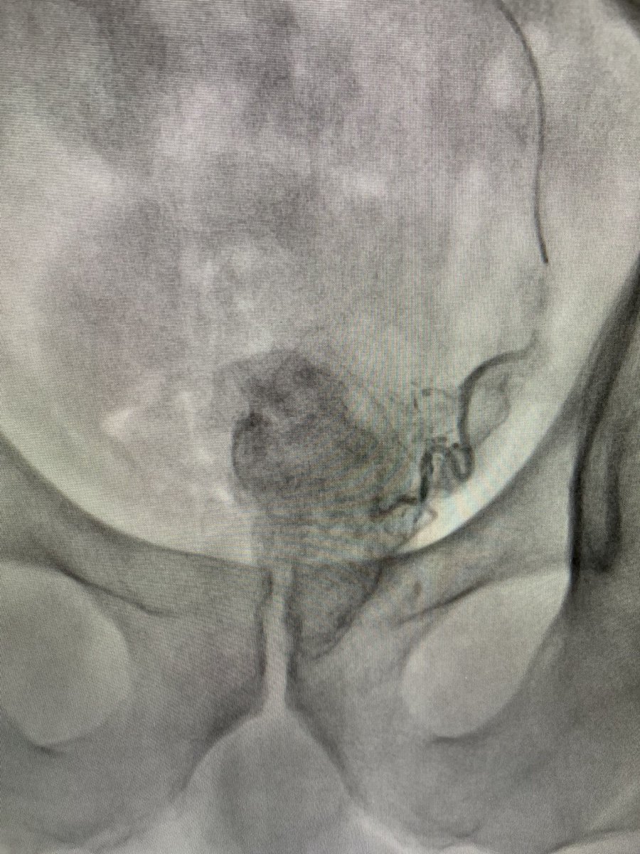 One of the best post-embolization fluoro images I have seen in a while. I inject a gel foam slurry after the particles to fill the distal main prostatic artery and prevent early recanalization. <a href="/SIR_ECS/">SIR ECS</a> <a href="/SIRRFS/">SIR RFS</a> <a href="/IR_juniors/">IR Juniors</a> <a href="/PairsWeb/">PAIRS</a> <a href="/CAIRweb/">Canadian Association for Interventional Radiology</a> <a href="/UsaProstate/">Prostate Centers USA</a>