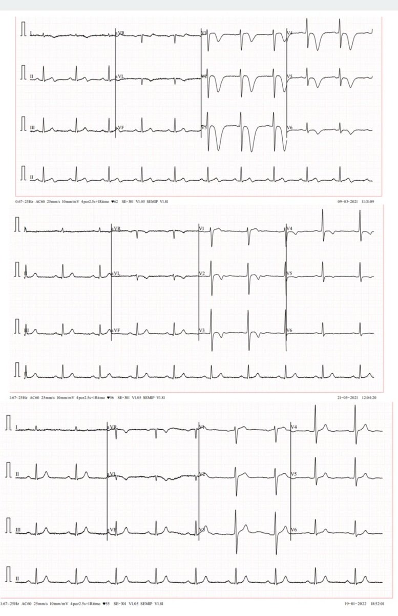 Juanmacor5's tweet photo. Evolución electrocardiográfica de un síndrome de wellens, tratado con angioplastía a una DA suboclusiva.
Marzo 2021
Mayo 2021
Enero 2022
#medtwitter #FOAMed #MedEd #ECG https://t.co/96GYGCWTja