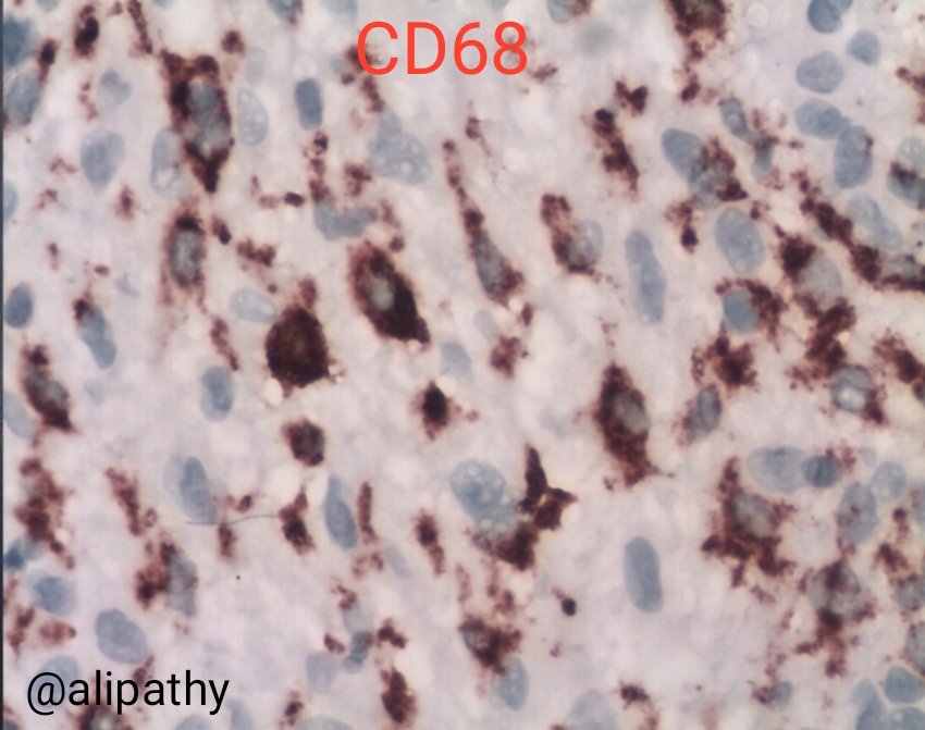Alipathy's tweet photo. #ihqpath #cd68 see previous post 👆🏻 https://t.co/TfgrfPuK7i