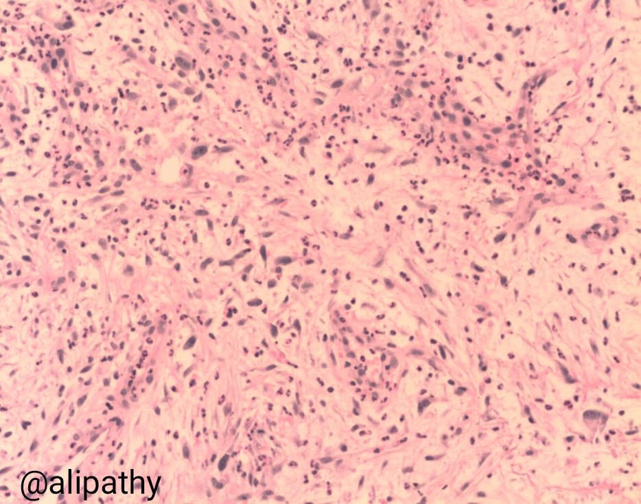 Alipathy's tweet photo. Dear #PathTwitter Family: What is your diagnosis? Lady 50y/o tumour at dorsi left hand. #IHQPath s100, cd34,AML and cd30 negativa. Cd68+ show in pic in comment #pathology #BSTpath https://t.co/iy3neQTFhh