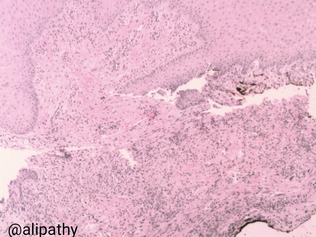 Alipathy's tweet photo. Dear #PathTwitter Family: What is your diagnosis? Lady 50y/o tumour at dorsi left hand. #IHQPath s100, cd34,AML and cd30 negativa. Cd68+ show in pic in comment #pathology #BSTpath https://t.co/iy3neQTFhh