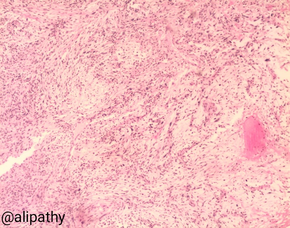 Alipathy's tweet photo. Dear #PathTwitter Family: What is your diagnosis? Lady 50y/o tumour at dorsi left hand. #IHQPath s100, cd34,AML and cd30 negativa. Cd68+ show in pic in comment #pathology #BSTpath https://t.co/iy3neQTFhh