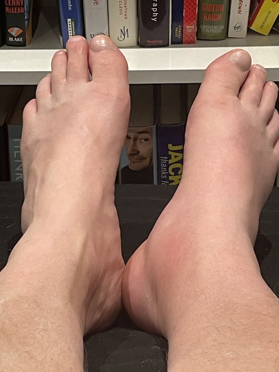 Can you tell which ankle has got gout, and is half the size it was yesterday - oh the pain 🤦🏻‍♂️🤦🏻‍♂️🤦🏻‍♂️