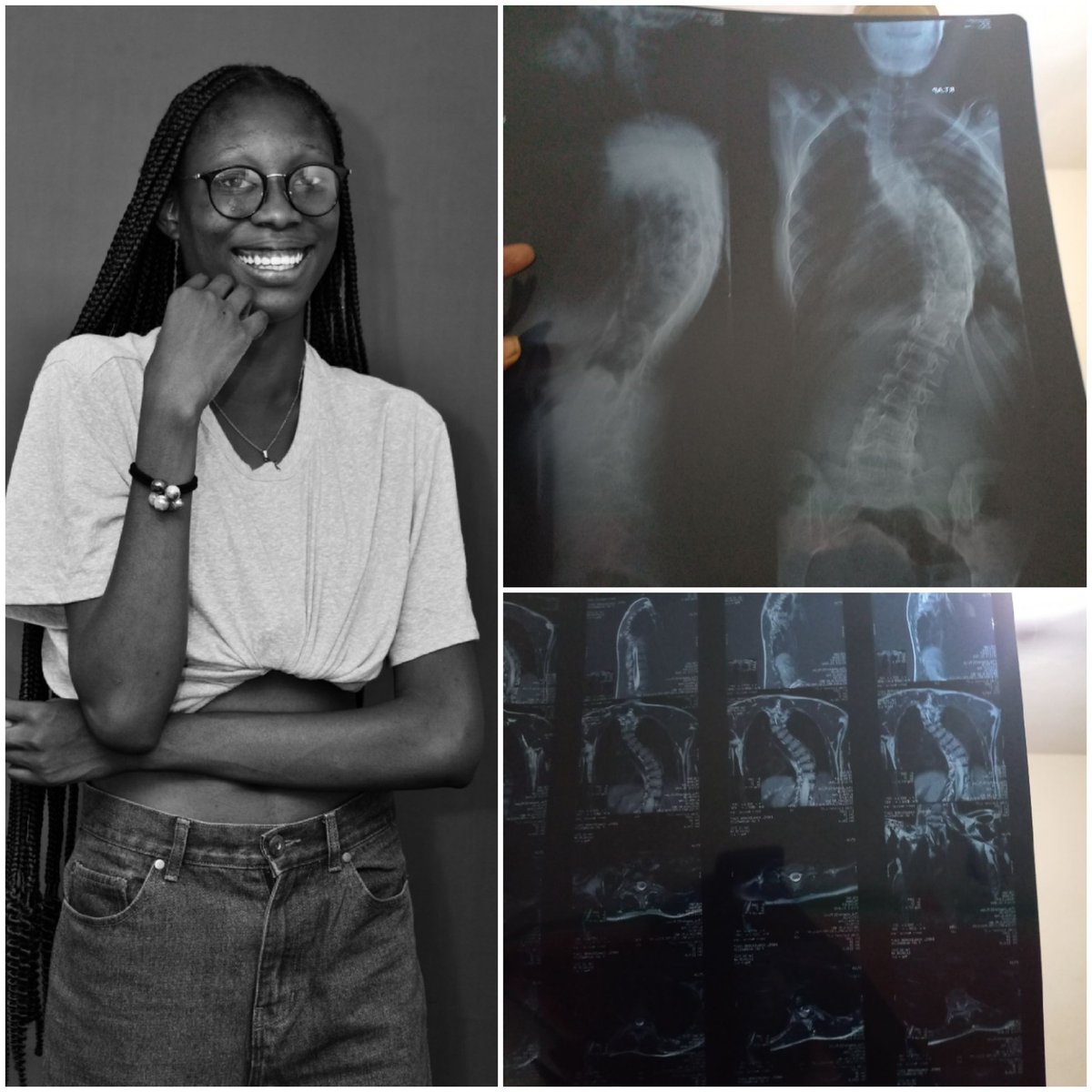 ogee_bby's tweet photo. Scoliosis is not a slight hunched back, scoliosis is a disease that affects a person physically, emotionally and mentally, the past six years since I have been diagnosed of scoliosis hasn't been easy for me. The sleepless nights, severe back aches, irregular heartbeat (A THREAD) https://t.co/8WnTQgh6eS