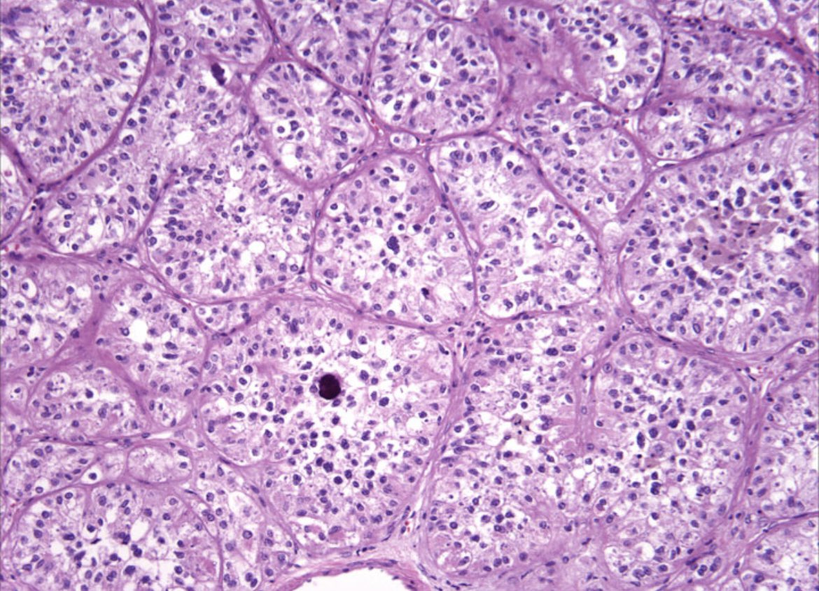 GU PATHOLOGY FELLOWSHIP! We have added a 2nd GU Fellowship position <a href="/BWHPath/">Brigham and Women's Pathology</a> &amp; have openings for July ‘22 &amp; ‘23. Great academic opportunity for pathologists-in-training with a sincere GU interest Email/PM me if interested.🔬
<a href="/GU_Path_Society/">GU Pathology Society (GUPS)</a> <a href="/IntSocUropath/">International Society of Urological Pathology</a>
<a href="/Andres_M_Acosta/">Andres Martin Acosta (Andy)</a>