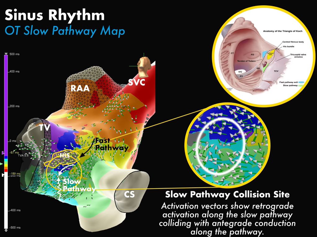 #EPeeps had a very fine day with #EnSiteX #HDGrid and #OT mapping slow pathway prior to #AVNRT ablation this week. Observed nice slow junctionals with RFA at site of collision. Non-inducible post-ablation. Maps by @MeganMalladiEP Figures by @sota_ep