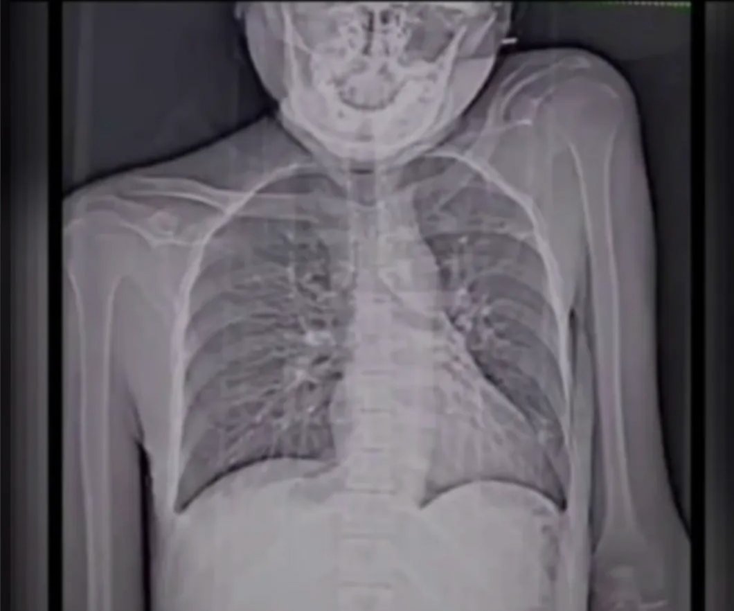 Pranshu71298418's tweet photo. Acute Pushpaitis 😜 #MedEd #MedTwitter https://t.co/tOrh7NrxLk
