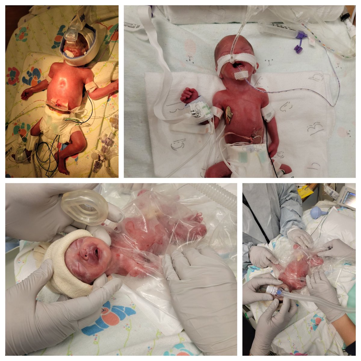 coachKooima's tweet image. These two tough dudes are finally home! 160 days of miles, hospital rooms, Dr. evals, nurse calls, and long hospital days. We are all finally under one roof! Thank you all for the prayers! #twolittlemiracles #familyof6