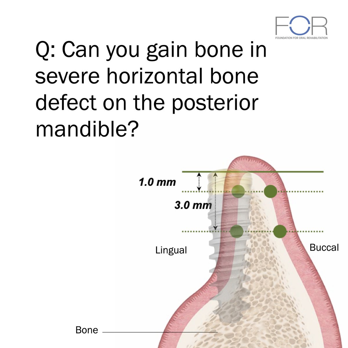 for_org's tweet photo. Dr. Zoran Aleksic presents a multi-center prospective study evaluating GBR in the restoration of horizontal defects in the posterior mandible.
Click here: https://t.co/dxvVnWGXxT and DOWNLOAD THE POSTER.
#FORdental #encorepresentation #scientificresearch https://t.co/U6tqqTkTzZ