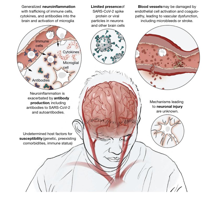 gorka_orive's tweet photo. Los efectos neurológicos (depresión, jaquecas, psicosis, confusión) tras infección son parte de las posibles secuelas de la COVID19 persistente. La neuroinflamación y una respuesta inmunitaria alterada como posibles mecanismos fisiopatológicos.
https://t.co/QNMs5bhSMI https://t.co/QTW6RwyJ5B