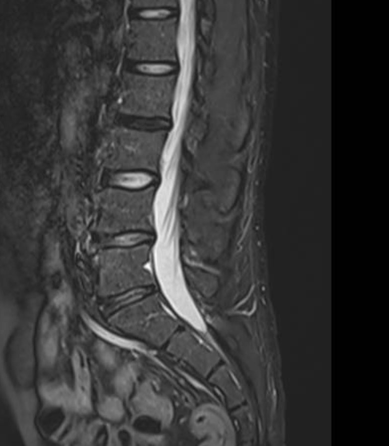DrJN_SportsMed's tweet photo. what do we think about the anterior  changes around L4/5 here? 🤔 https://t.co/cvU8pVIibl
