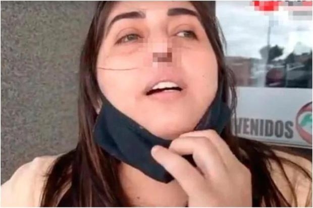 kankokuseikei's tweet photo. 【PCR検査しすぎで鼻の軟骨が⁉️⁉️】
アルゼンチンの介護職の女性は頻繁にPCR検査を受けていたそうで、ある日のPCR検査でゼラチンのような血が出てから鼻の部位が赤くなり、鼻孔が4～ 5㎝ほど腫れ
鼻が感染して鼻の軟骨が腐敗🥶
軟骨再建手術が約46万円だそうです💦
https://t.co/SK9Rss2TFT https://t.co/DLcxZIgMur