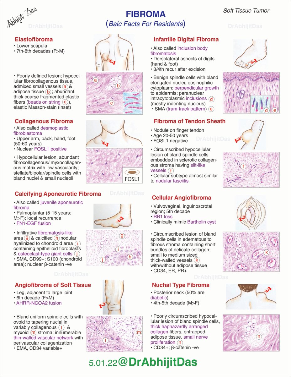 FIBROMA (Soft tissue tumors) Some of the basic facts for residents.. #MakeSurgiPathEasy #FibromaSoftTissue