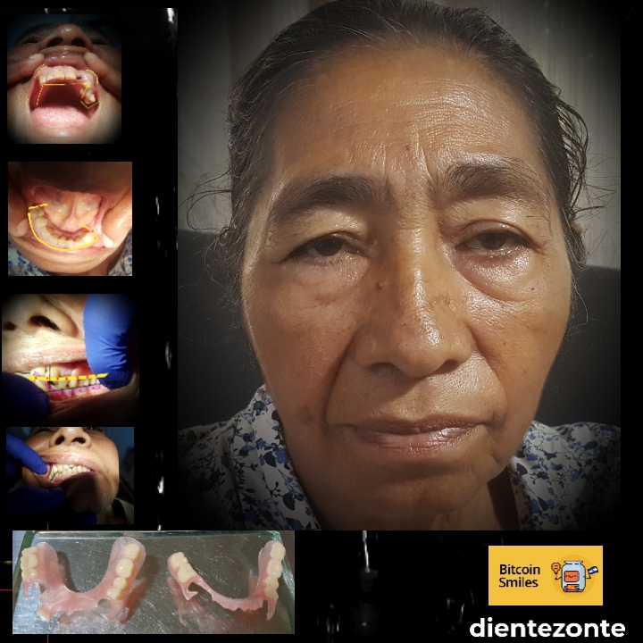 BitcoinSmiles's tweet photo. Case #13 - María Isabel is 65yo housewife working on the field to support her son who is blind and got his leg amputated recently. Her dental rehabilitation despite complexities is now a reality. #BitcoinFixesTeeth https://t.co/84CZQfuYN4