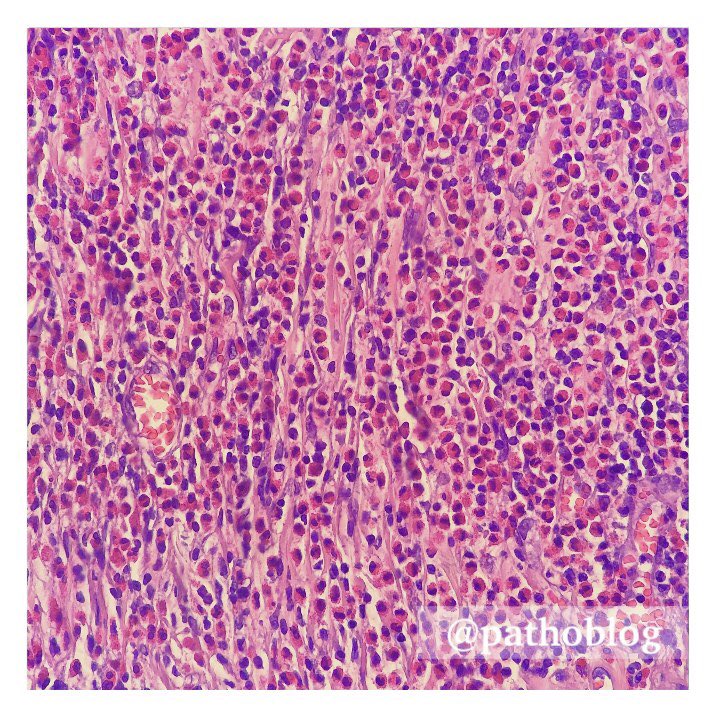pathoblog's tweet photo. 66 y.o. female. Prominent eosinophilic infiltrate in the bladder.
โ
The patient has been treated for a long time for recurrent urothelial carcinoma.
โ
#pathoblog #pathtwitter #GUpath #bladder #pathology #pathologist #pathologists https://t.co/cpQOoyMhvh