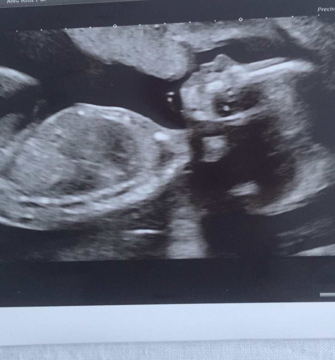 charlotteadgie's tweet photo. Annnnnnd we’re half way there 😍♥️🤰🏻

Baby Ralph cooking nicely, measuring bang on 20 weeks, absolutely perfect 🥰
#20weekspregnant #20weekstogo https://t.co/jdyRsUZhZz