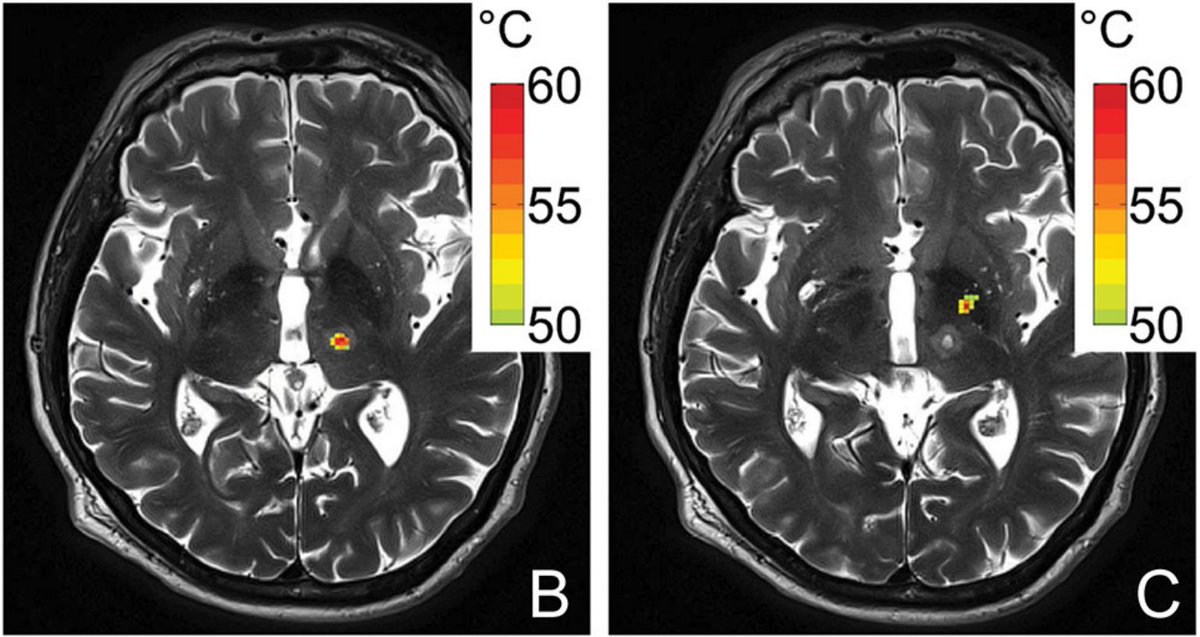 Maryland Neurosurgery (@umdneurosurgery) on Twitter photo Congrats @Abdul_K_Ahmed PGY-4, Dr. Gandhi, and team for this new publication in <a href="/FrontNeurol/">Frontiers - Neurology</a> quantifying the differences in performing a VIM thalamotomy and GPi pallidotomy with focused ultrasound: medial targets are easier to lesion, this is why | Read:bit.ly/33vlyzy Congrats @Abdul_K_Ahmed PGY-4, Dr. Gandhi, and team for this new publication in <a href="/FrontNeurol/">Frontiers - Neurology</a> quantifying the differences in performing a VIM thalamotomy and GPi pallidotomy with focused ultrasound: medial targets are easier to lesion, this is why | Read:bit.ly/33vlyzy