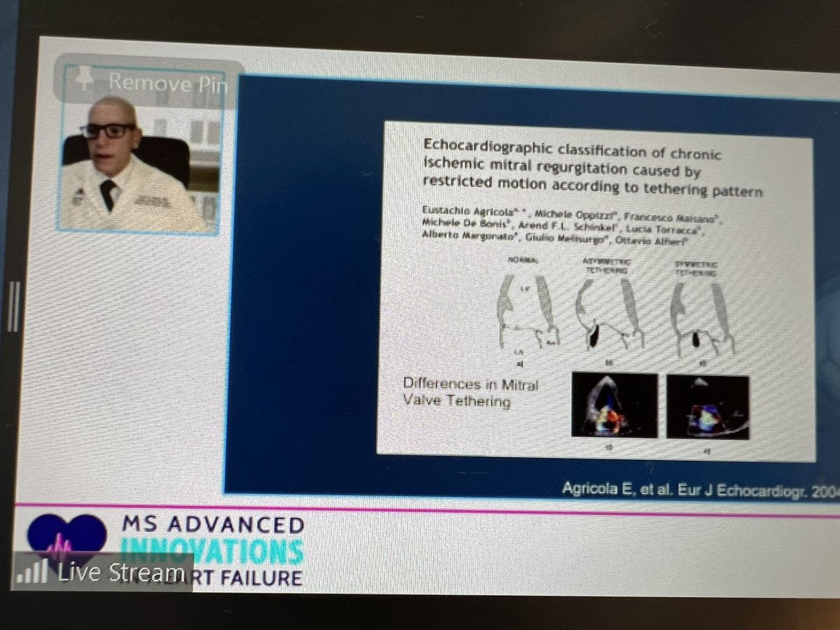 dranulala's tweet photo. HAPPENING NOW!!! 
🫀GIANTS! Multidisciplinary management of #FunctionNotFailure 
@ACCinTouch @AHAScience 
@MountSinaiNYC 
David Adams, @Drroxmehran @GreggWStone John Puskas @MichaelTongMD @GilbertTangMD 
#CardioTwitter #CTSurgery #EPeeps @SCAI 
https://t.co/JnWyG39V2f https://t.co/S3C1Oo3R2O