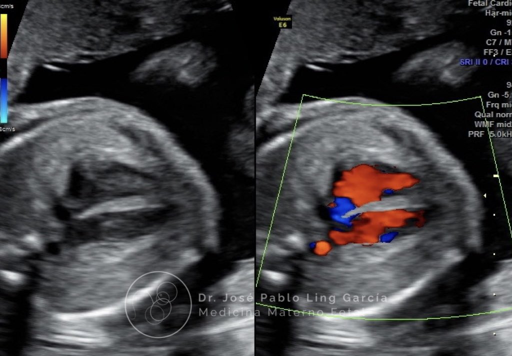 Drpabloling's tweet photo. Imagen de 4 cámaras de corazón fetal 🫀

#ecografia #corazon #feto #embarazo #embarazosano #fetal #obstetricia #tbt https://t.co/lncEa4AOnW