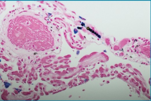 Researchers studied the addition of the anti-PD-L1 antibody #immunotherapy, durvalumab, to #chemo in #patients with malignant pleural #mesothelioma. OT connected with Dr. Valsamo Anagnostou <a href="/ValsamoA/">Elsa Anagnostou</a> at <a href="/hopkinskimmel/">Johns Hopkins Kimmel Cancer Center</a> for more insights.: ow.ly/XhLZ50HzYbq