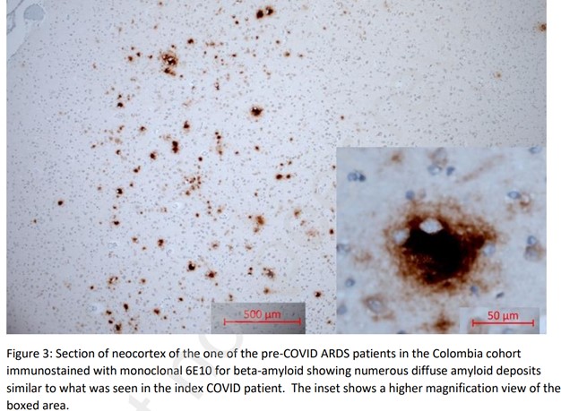 Aguirre1Gustavo's tweet image. #LongCOVID,#CFS:
Amyloid deposits identified in the brain
in 10 of 10 Adults 37 to 58 years old
with up to 5 months from the start of COVID symptoms.
Associated with hypoxia
Our theory is that they are associated with #bioclots with high fibrin content
ssrn.com/abstract=40032…
#ME