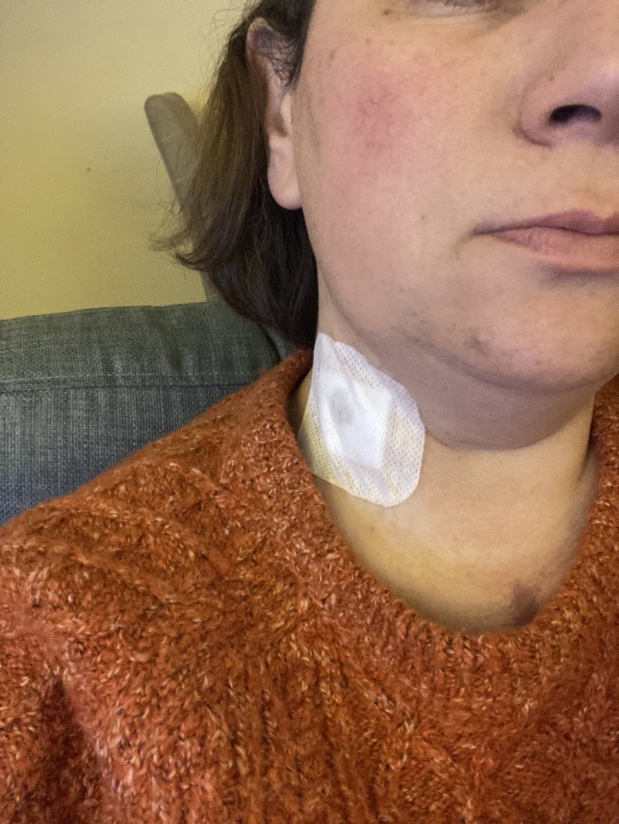 Gemkmassie's tweet photo. Clinic day yesterday ๐ญ๐ญ๐ญ how I hate you! No tears though (first time ever). The being stabbed in your neck never gets easier for them to do the biopsy. #hearttransplant @uhbtrust #norejection #nearly6months @HTF_UK https://t.co/oy0Zg7loYr