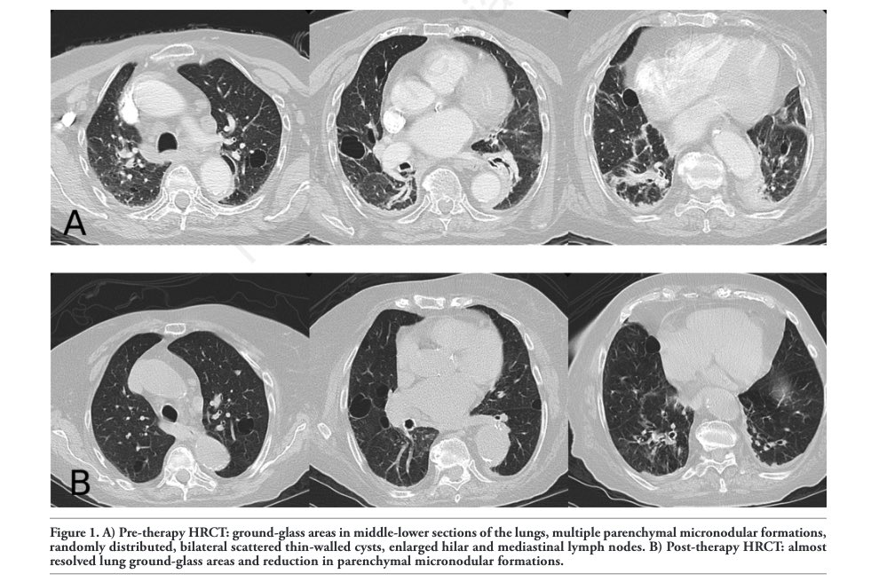 BeyondRheumatol's tweet photo. Lymphocytic interstitial pneumonia (LIP) is an inflammatory diffuse parenchymal lung disease, which is associated with other conditions, such as autoimmune diseases and immunodeficiency states, and usually affects women with a mean age of 50 years. https://t.co/RV9yKXtKlq https://t.co/pKYNXtoOZr