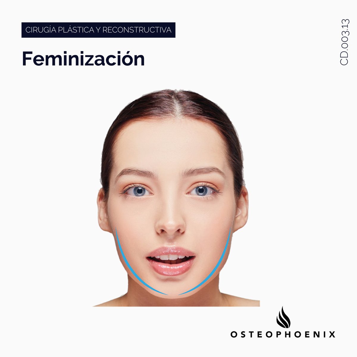 OsteophoenixSL's tweet photo. Gracias a la tecnología CAD-CAM, se pueden planificar los cortes que se van a realizar y en base a eso diseñar y manufacturar las guías de corte con su correspondiente dispositivo de osteosíntesis a medida. 
https://t.co/IziCXfjkuf https://t.co/11jiRSV3MG