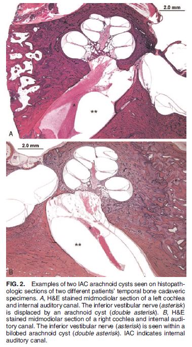 A rare, or possibly rarely described, entity not to forget when an MR seems 'negative' for SNHL, esp if there's history of trauma. Follow CN VIII in the IAC on hT2W seq, see if there might be a focal deviation that might just be a tiny IAC arachnoid cyst!
pubmed.ncbi.nlm.nih.gov/34999615/