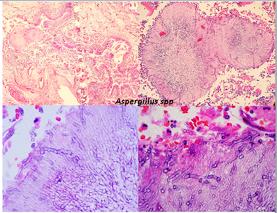 PathologySp's tweet photo. Chronic necrotising aspergillosis is locally invasive is seen in patients with immunodeficiency or chronic lung disease. Aspergilloma is a fungus ball that develops in a pre-existing cavity in the lung parenchyma. Acute angled dichotomous branching hyphae found in necrotic tissue https://t.co/EusxoQRay4