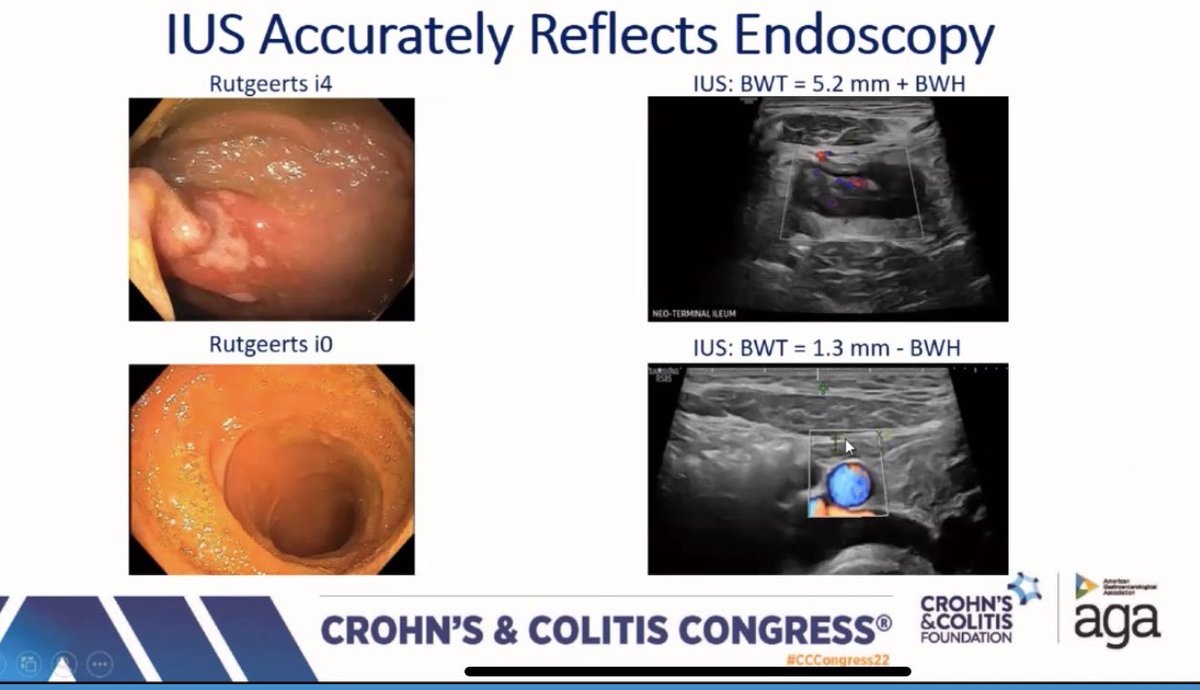 JKurowskiMD's tweet image. @DrMikeDolinger shows us intestinal US correlates to Rutgeerts post-ICR in CD.  High provider agreement, similar to MR &amp;amp; CT.  Need more in #pedsgitwitter #CCCongress22