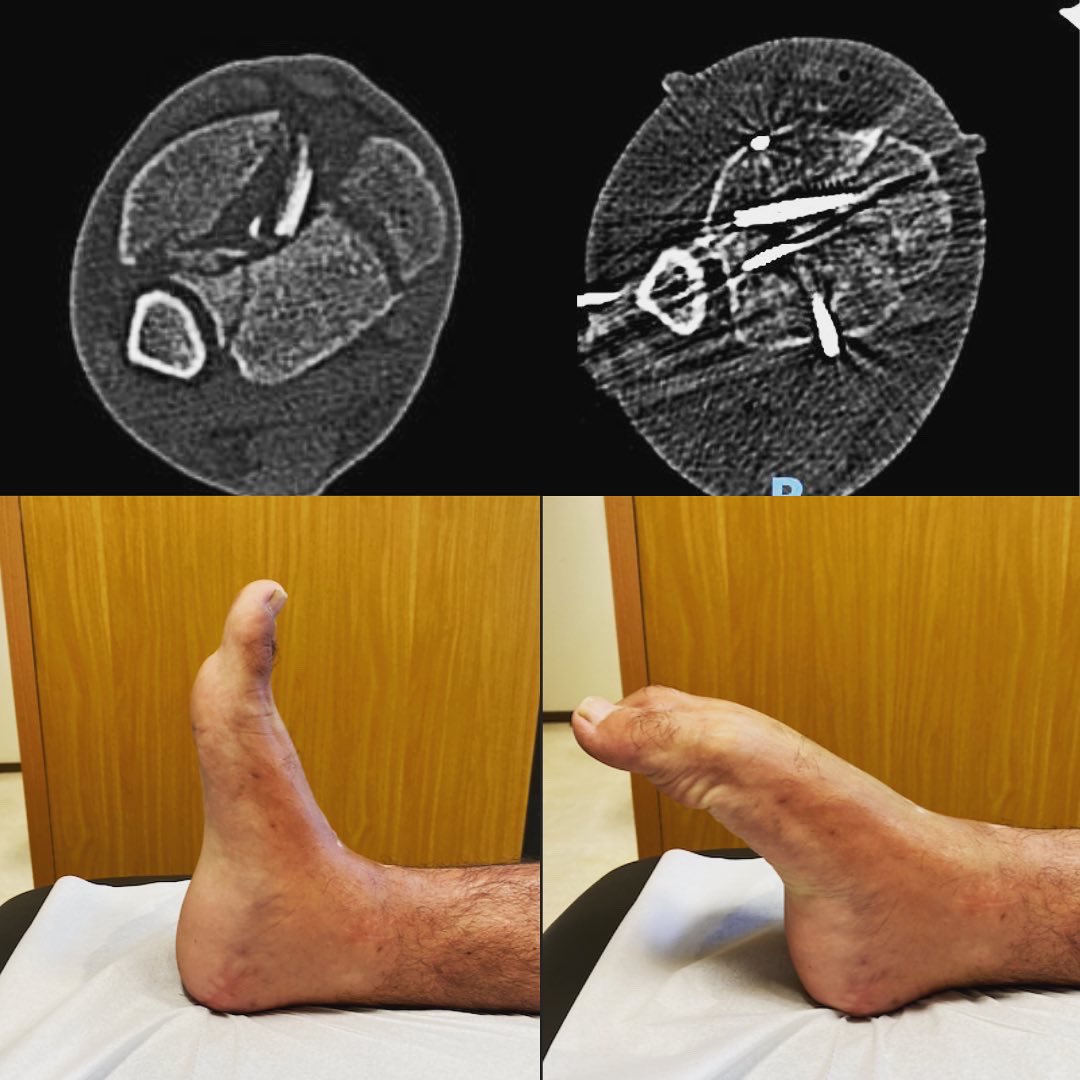 GonzaloBastias's tweet photo. Comminuted open pilon fracture. Minimally invasive management with excellent radiological and clinical results. 

#orthopedics #openfracture #pilonfracture #orthopedictrauma #minimallyinvasive #hexapod #orthotwitter #ilizarov https://t.co/iSquDh4Cn0