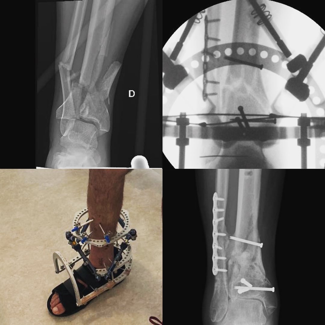 GonzaloBastias's tweet photo. Comminuted open pilon fracture. Minimally invasive management with excellent radiological and clinical results. 

#orthopedics #openfracture #pilonfracture #orthopedictrauma #minimallyinvasive #hexapod #orthotwitter #ilizarov https://t.co/iSquDh4Cn0