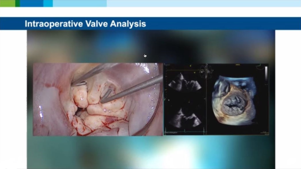 echo_stepbystep's tweet photo. It is very important a correlation between in vivo vs. #3D Echo
Online #3DWorkshop by @NMerke
@eromerodorta @KemalogluOz @iamritu @mirvatalasnag @KardiologieHH @dr_benoy_n_shah @ToDoenst https://t.co/2SasySC9eW
