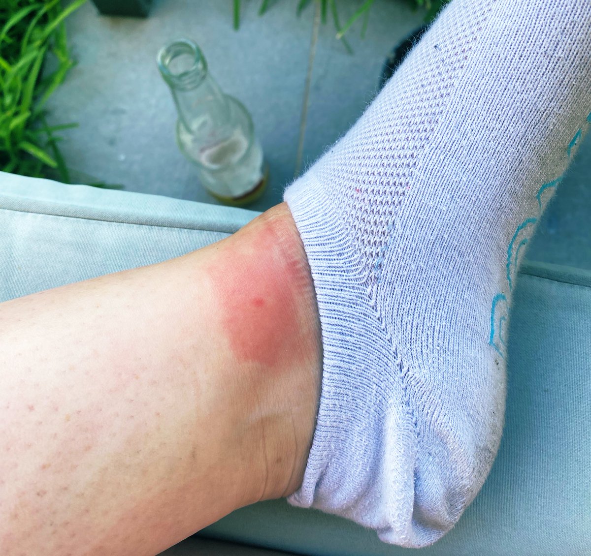 melymelbs's tweet photo. When you get a mozzie bite do they end up as massive fucking welts or are you normal? https://t.co/SISDXw8HpM