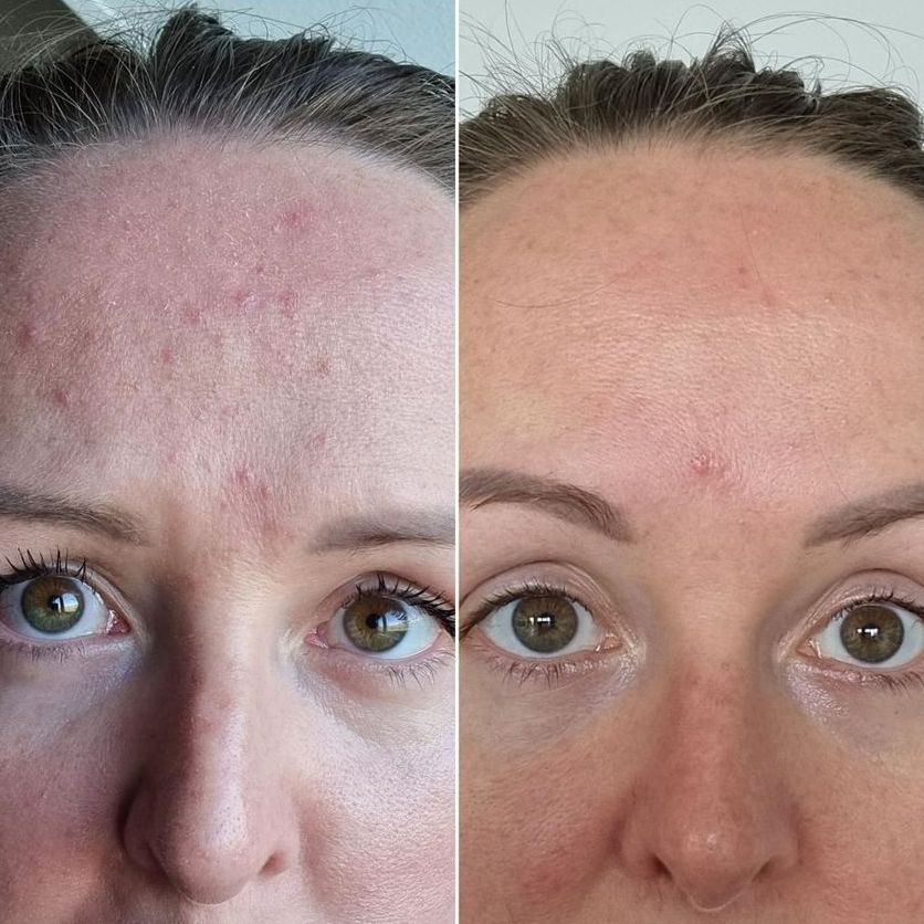 A truly beautiful skin transformation from the gorgeous Stacey after just 1 month of using a probiotic routine 🌟 Find the perfect routine to achieve your skin health goals using our new Aurelia B.I.O personalised skincare routine tool: bit.ly/3K6gYYT