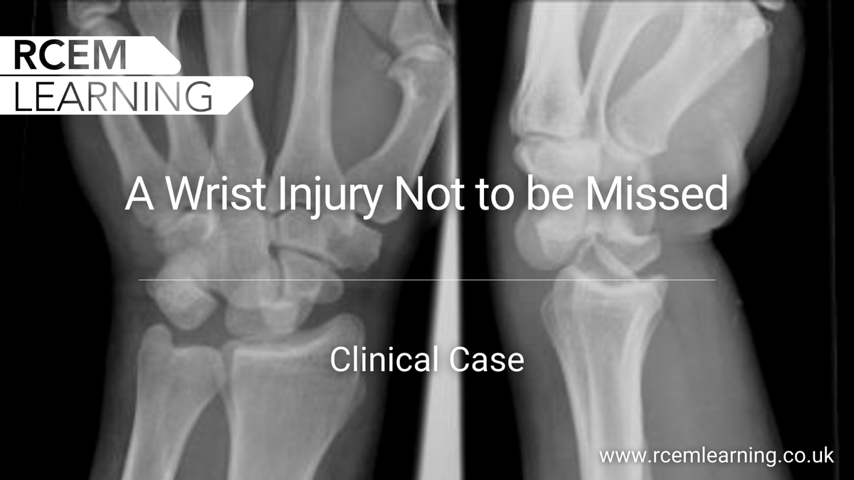 RCEMLearning's tweet photo. A 32-yr-old male presents to the ED following a fall on his outstretched left hand from a height of 1.5m 🖐️ On examination there was diffuse pain, tenderness, swelling &amp; a reduced range of movement.

Take a look at his x-ray. What does it show?

#FOAMed ➡️https://t.co/C2jzfAqJRE https://t.co/XsHP03xQ22